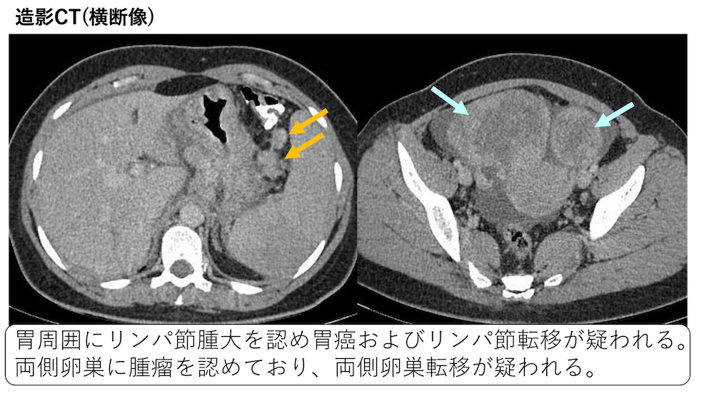 転移性卵巣腫瘍のCT、MRI画像診断(卵巣転移)